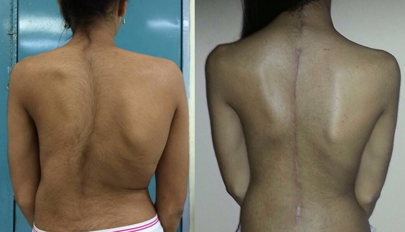 cost of scoliosis treatment in India