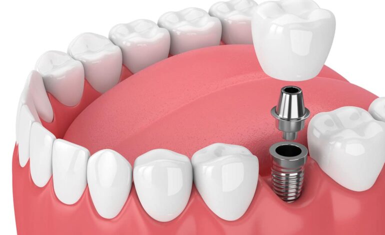 dental-implant